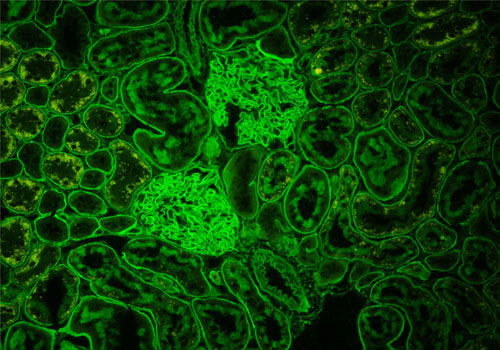 Pozitívne sérum pacienta s protilátkami proti bazálnym membránam glomerulov pri anti GBM glomerulonefritíde. Vyšetrené na tkanive obličky.